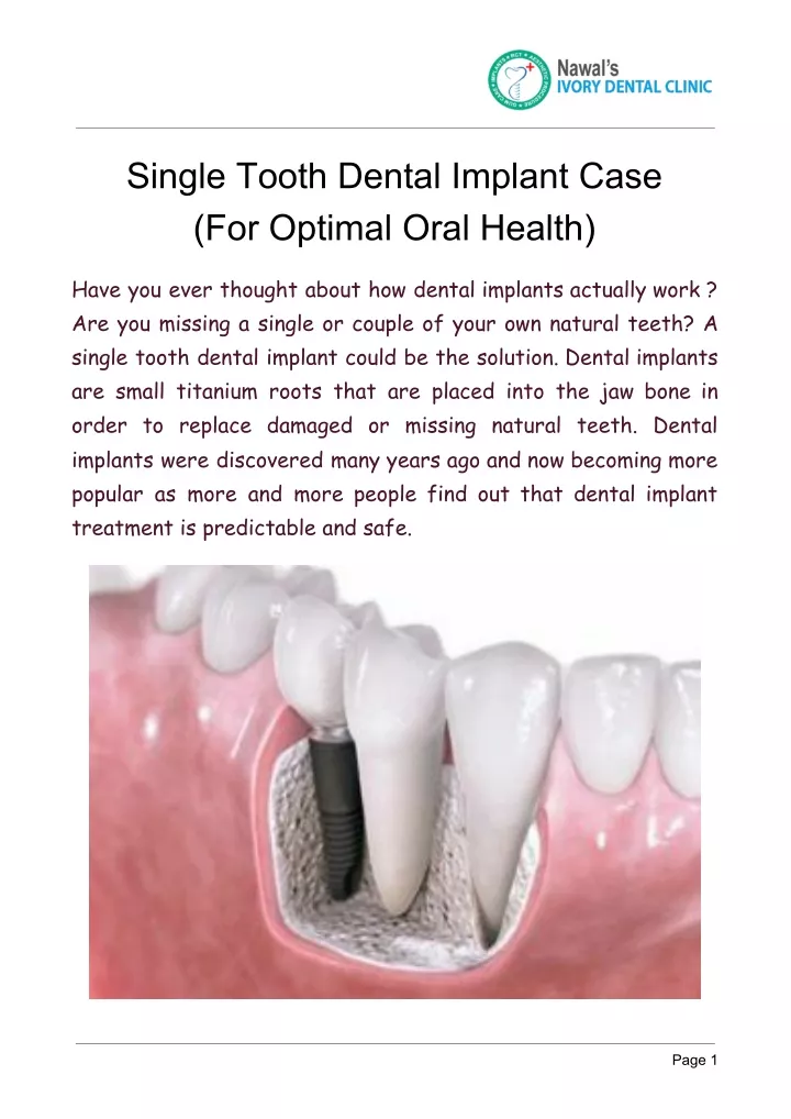 single tooth dental implant case for optimal oral