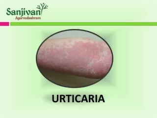 Urticaria Ayurvedic Treatment in Ghaziabad