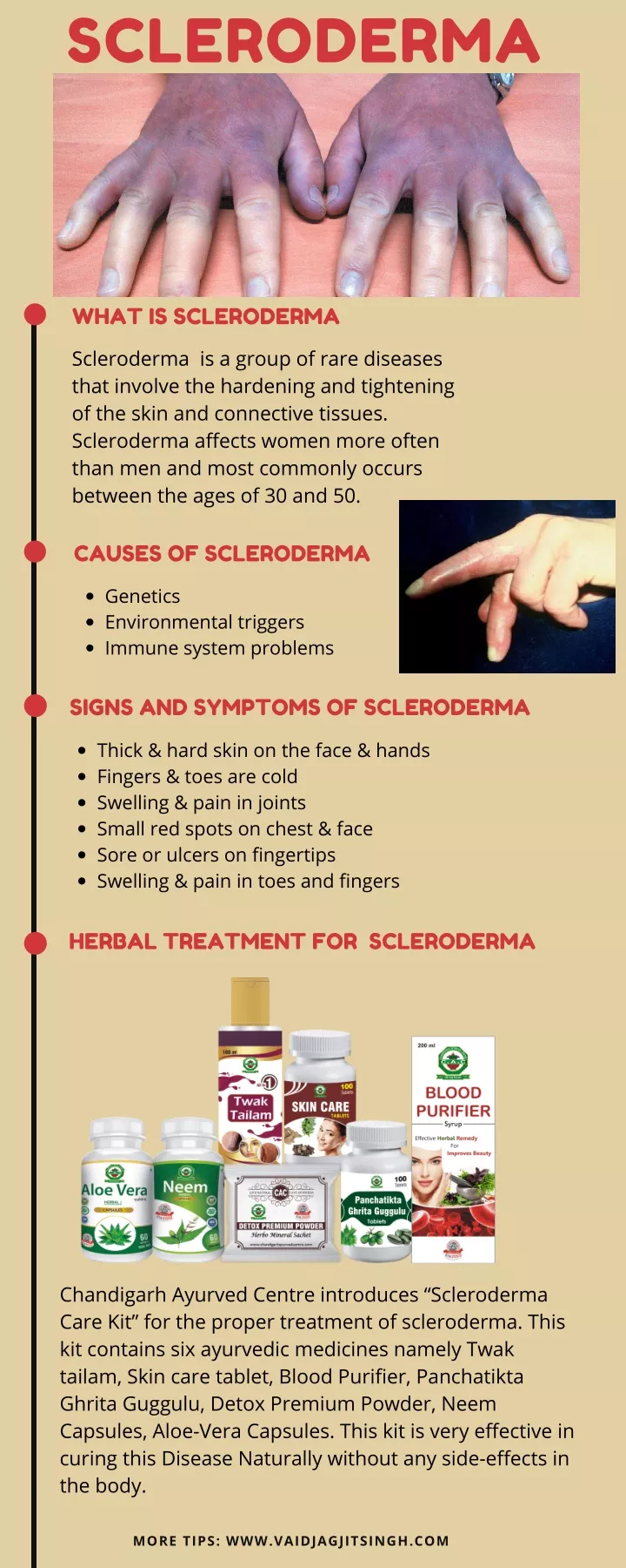 scleroderma