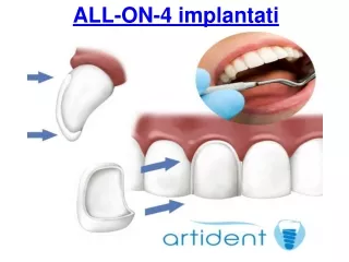 all on 4 implantati