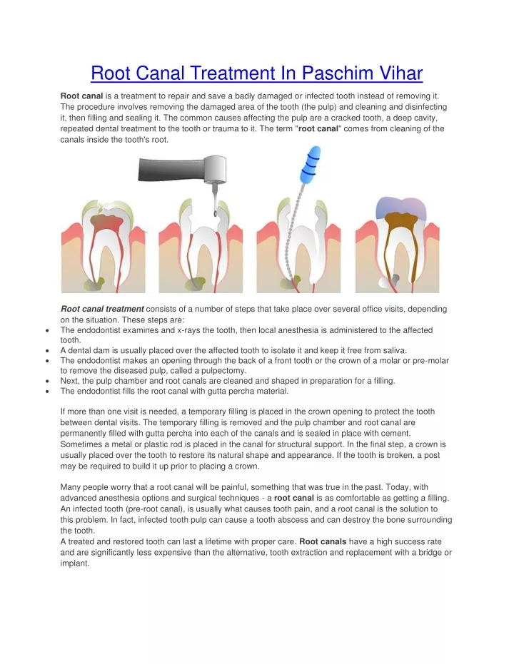 root canal treatment in paschim vihar