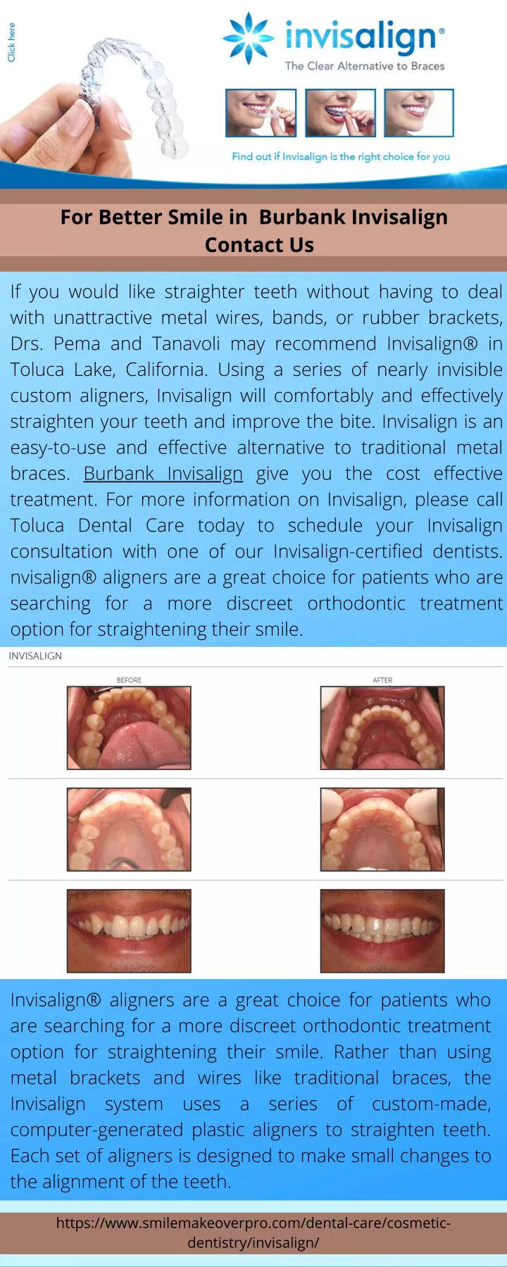 for better smile in burbank invisalign contact us