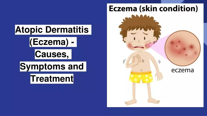 atopic dermatitis eczema causes symptoms