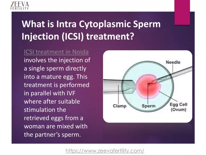 what is intra cytoplasmic sperm injection icsi treatment