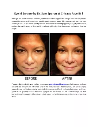 Eyelid Surgery by Dr. Sam Speron at Chicago Facelift !