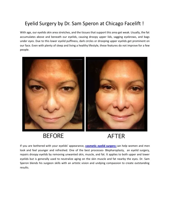 eyelid surgery by dr sam speron at chicago