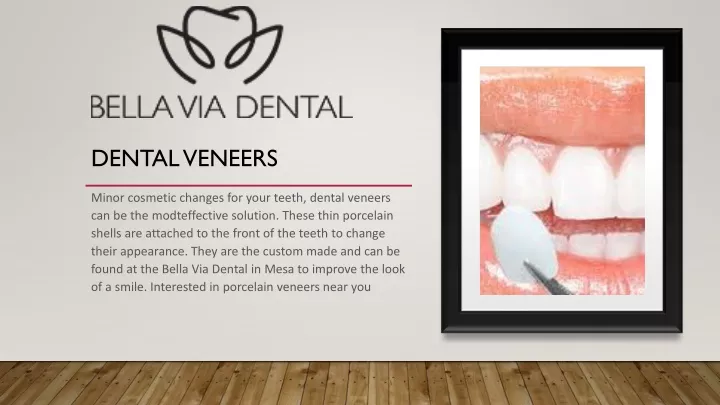 dental veneers