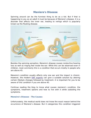 meniere s disease