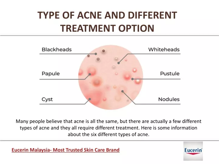 type of acne and different treatment option