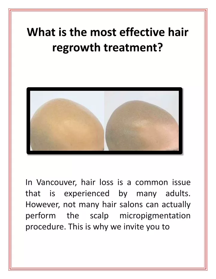 what is the most effective hair regrowth treatment