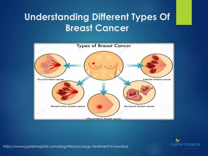 understanding different types of breast cancer