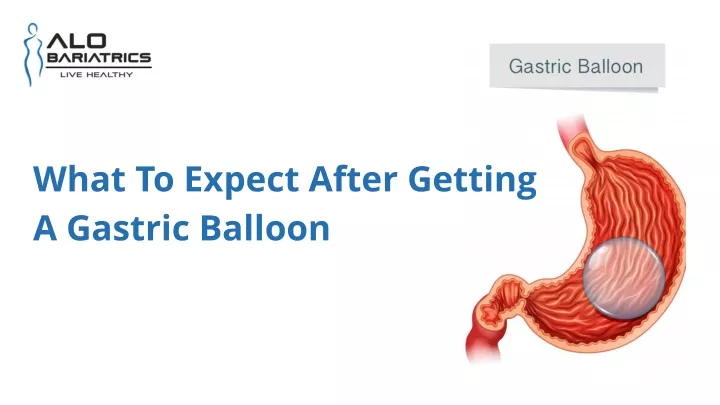 what to expect after getting a gastric balloon