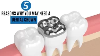 5 Reasons Why You May Need a Dental Crown