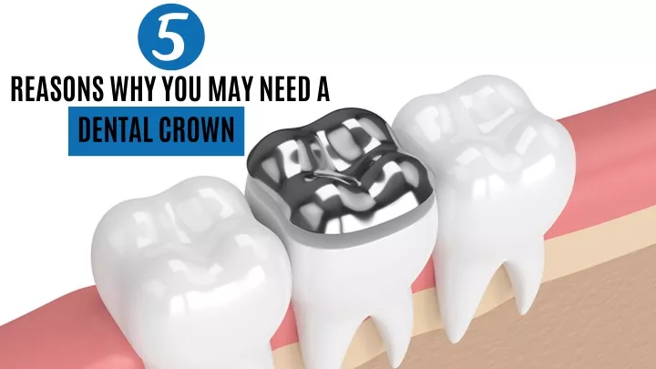 reasons why you may need a dental crown