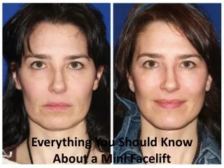 Non-Surgical Mini Facelift