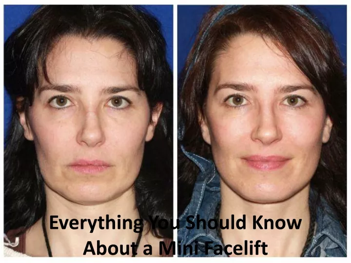 everything you should know about a mini facelift