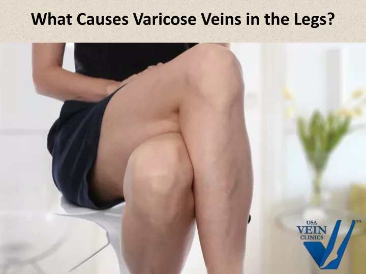 what causes varicose veins in the legs