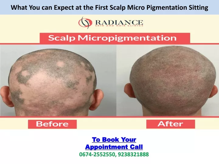 what you can expect at the first scalp micro pigmentation sitting