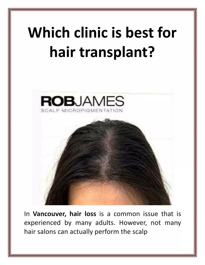 which clinic is best for hair transplant