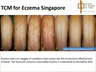TCM for Eczema Singapore