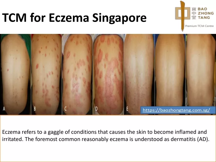 tcm for eczema singapore