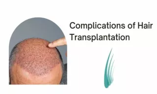 Complications of Hair Transplantation