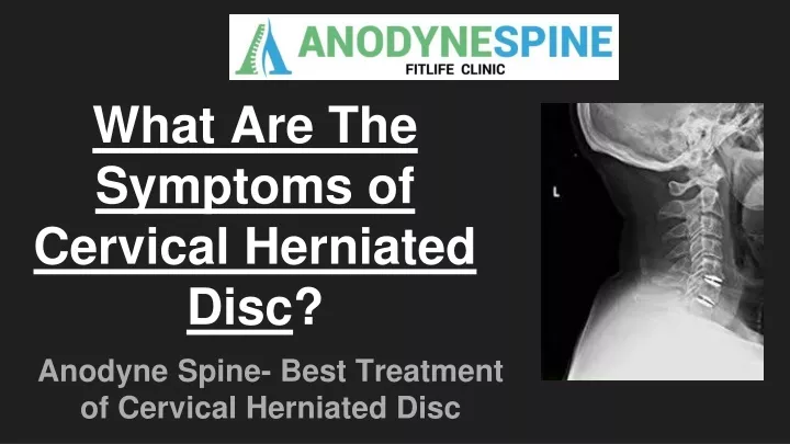 what are the symptoms of cervical herniated disc