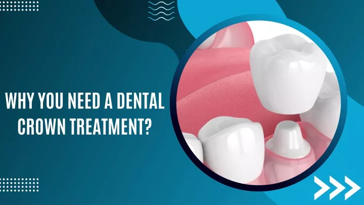 why you need a dental crown treatment