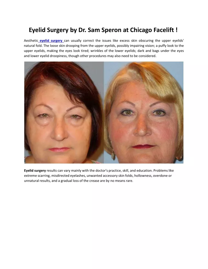 eyelid surgery by dr sam speron at chicago