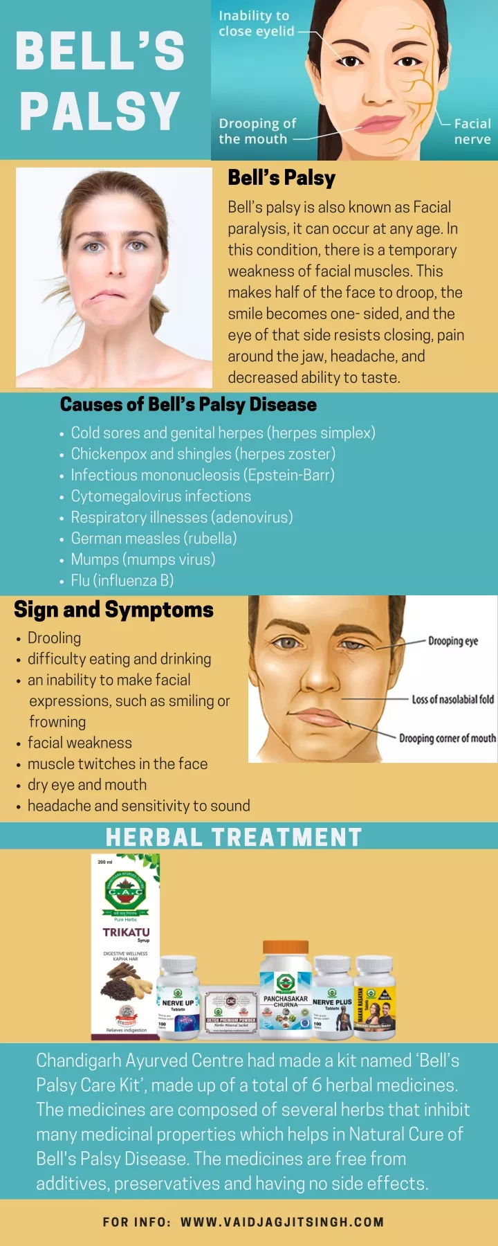 bell s palsy