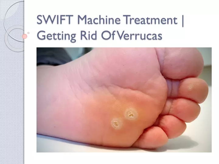 swift machine treatment getting rid of verrucas