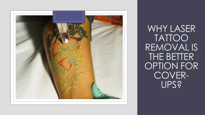 why laser tattoo removal is the better option for cover ups