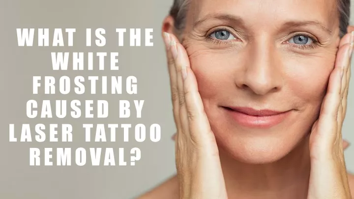 what is the white frosting caused by laser tattoo removal