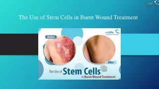 The Use of Stem Cells in Burnt Wound Treatment