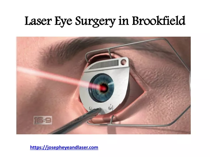 laser eye surgery in brookfield