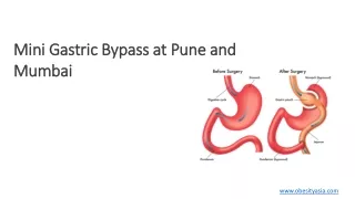 mini gastric bypass at pune and mumbai