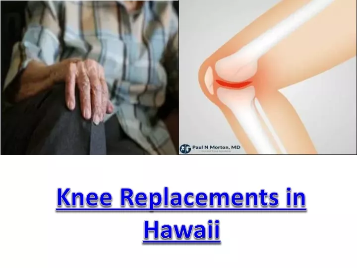 knee r eplacements in h awaii