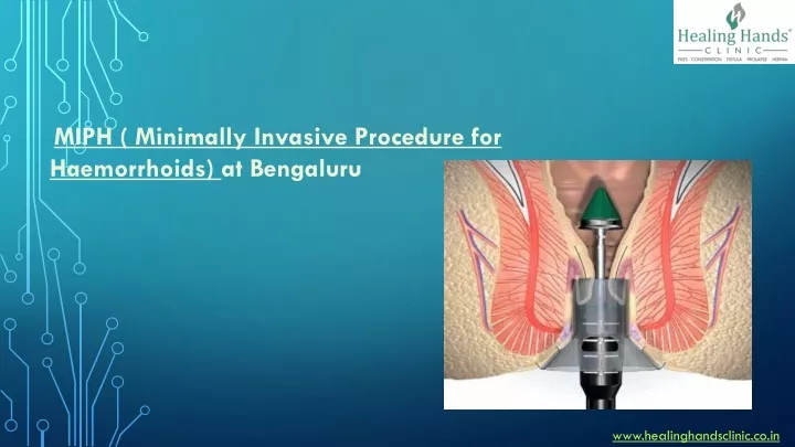 miph minimally invasive procedure