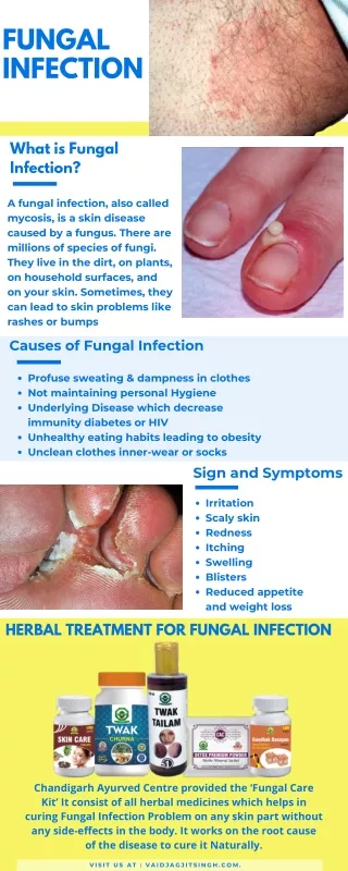 PPT - Fungal Nails in Blue Mountains: Causes, Symptoms, and Treatment ...