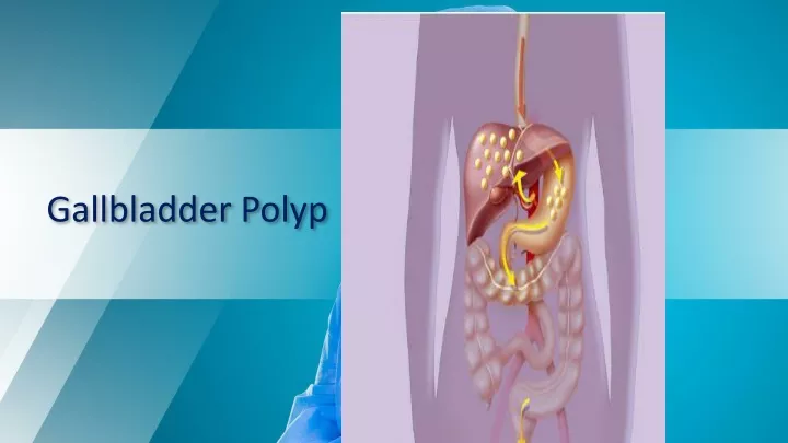 gallbladder polyp