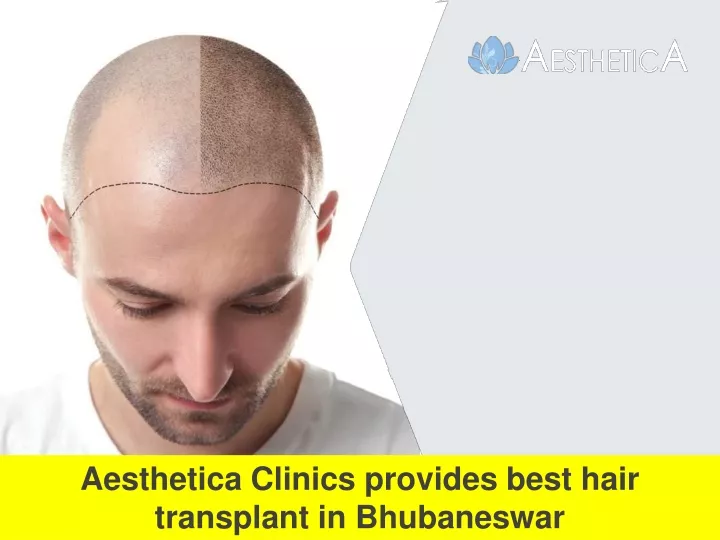 aesthetica clinics provides best hair transplant