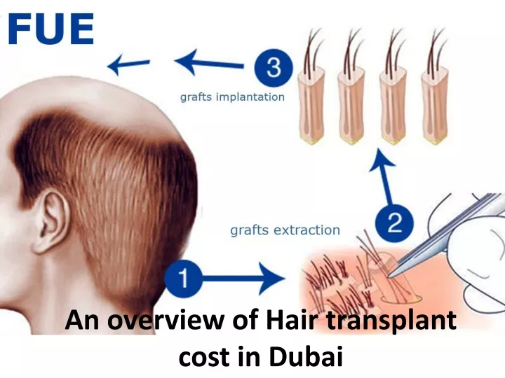 an overview of hair transplant cost in dubai