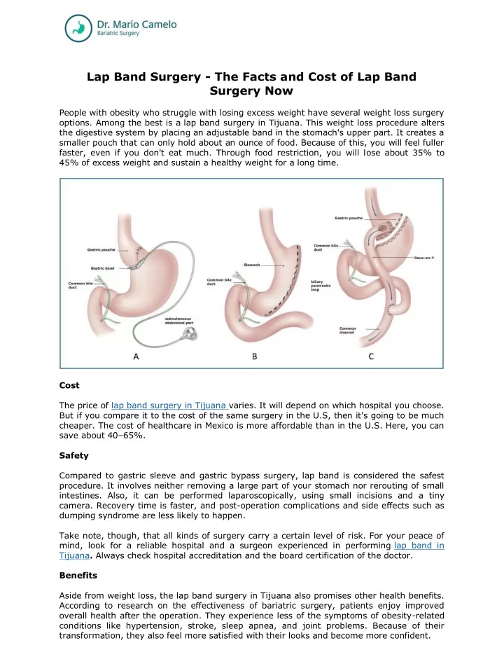 lap band surgery the facts and cost of lap band