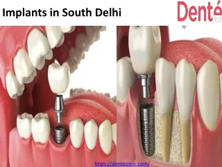 Dental implants in south delhi
