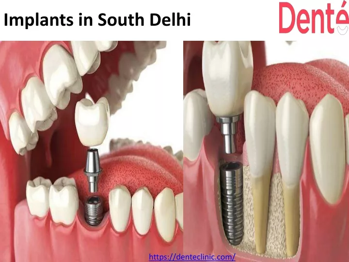 implants in south delhi