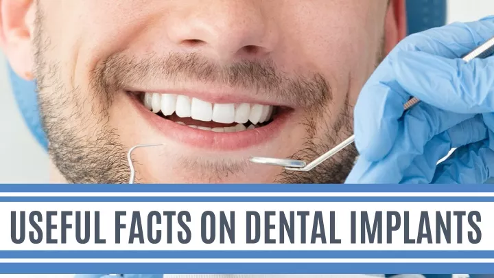 useful facts on dental implants
