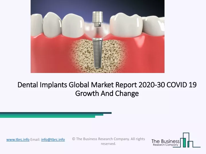 dental implants global market report 2020 30 covid 19 growth and change