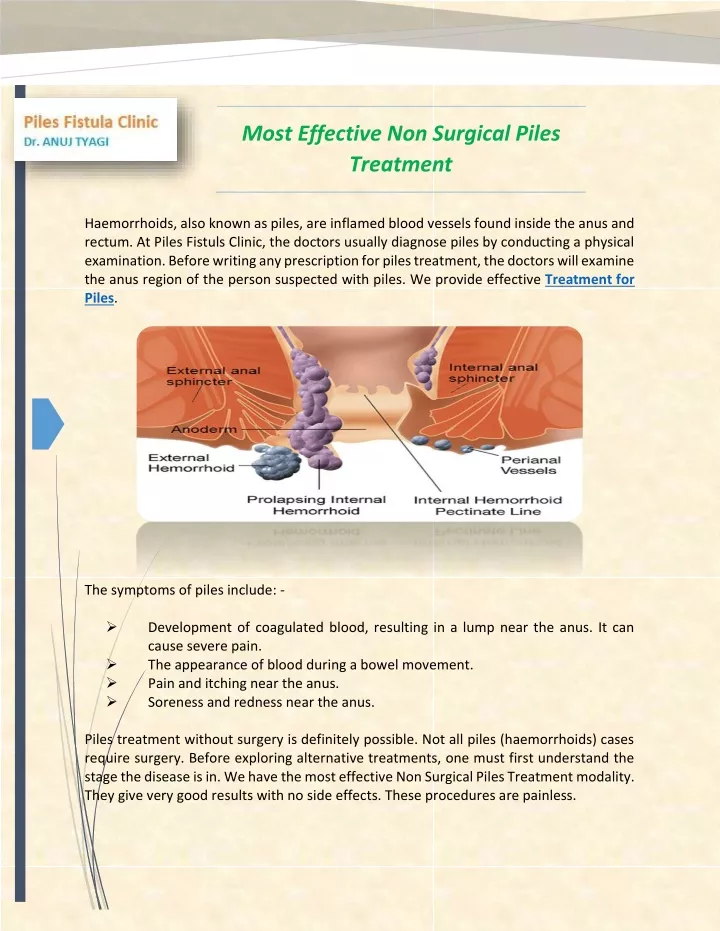 most effective non surgical piles treatment