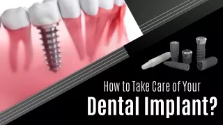 How to Take Care of Your Dental Implant?