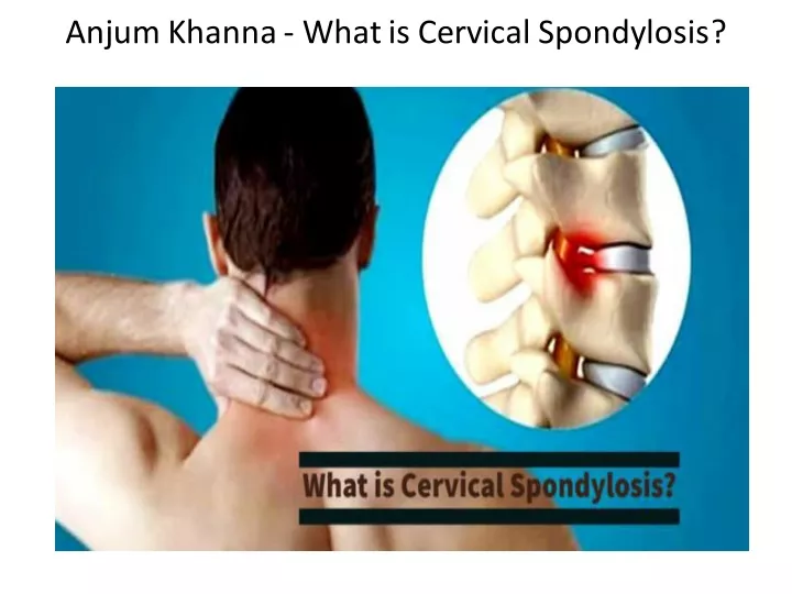 anjum khanna what is cervical spondylosis